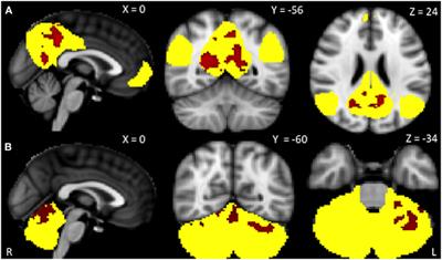 Abnormal Resting-State Functional Connectivity in Progressive Supranuclear Palsy and Corticobasal Syndrome